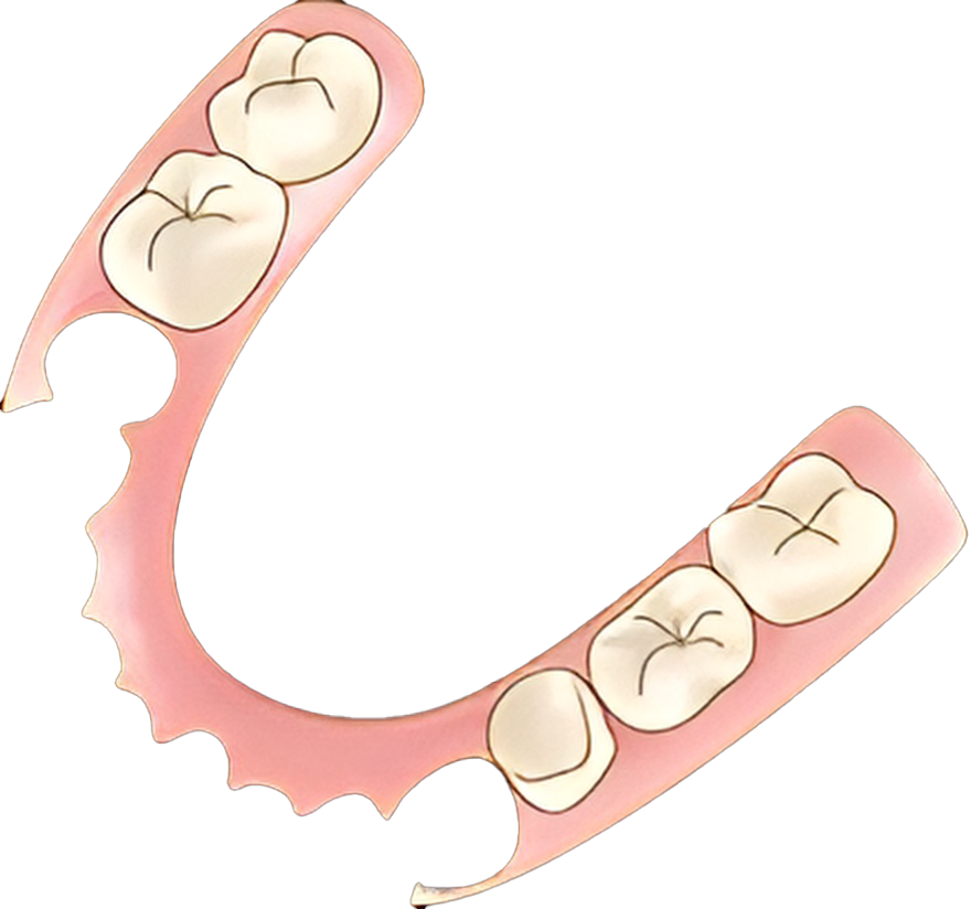 ノンクラスプデンチャー