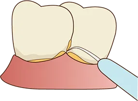 プラークコントロール